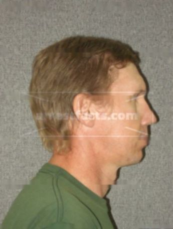 Bruce P Kunze