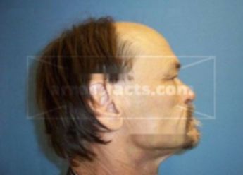 Jeffrey L Burkhart