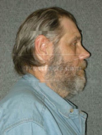 Bruce F Nelson