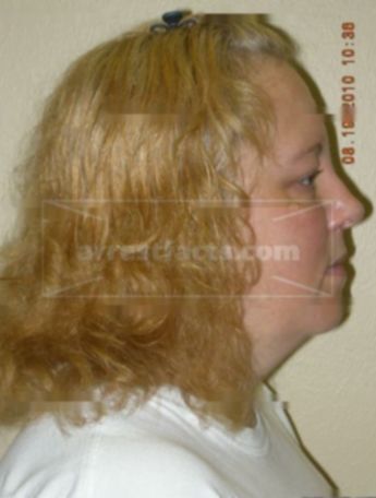 Rhonda L Lund