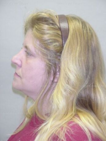 Suzette M Hilkemeier