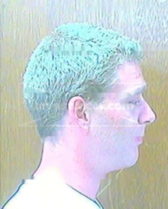 Patrick L Champlin